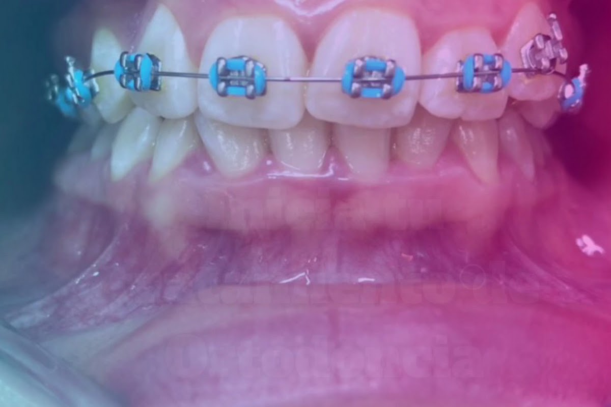 Tratamiento de ortodoncia real en Dental Care